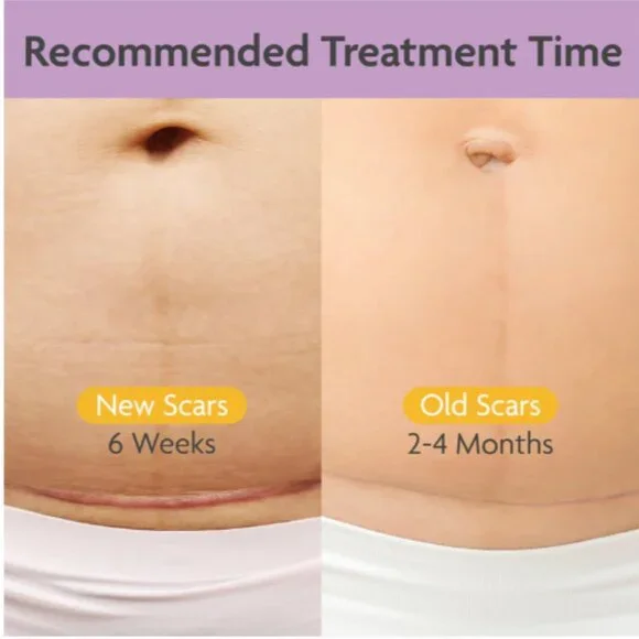 TriLASTIN C-Section Scar Sheet - Anchor - Picture 4 of 4